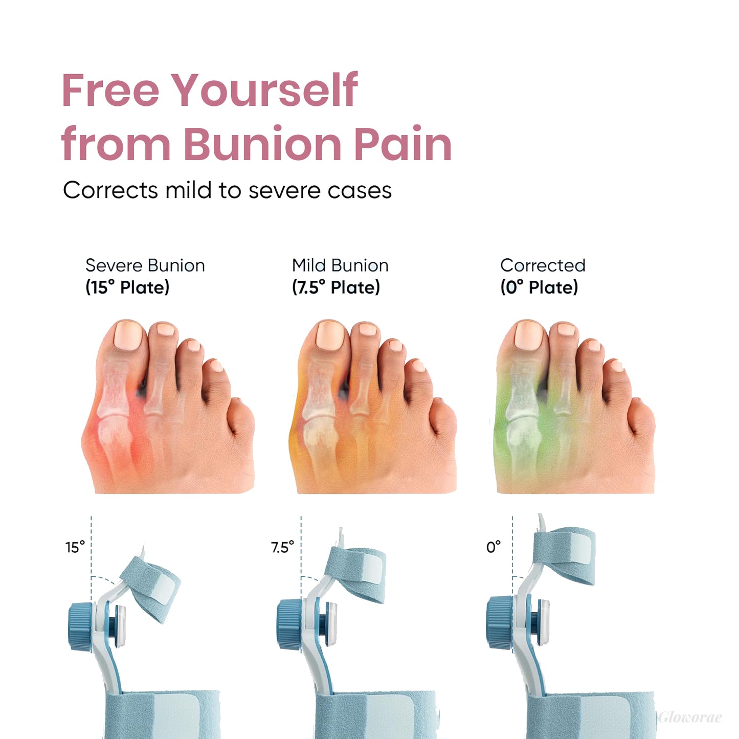 PediAlign™ Bunion Corrector