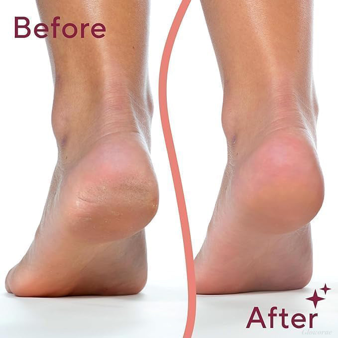 PediGlow™ Electric Callus Remover