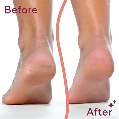 PediGlow™ Electric Callus Remover
