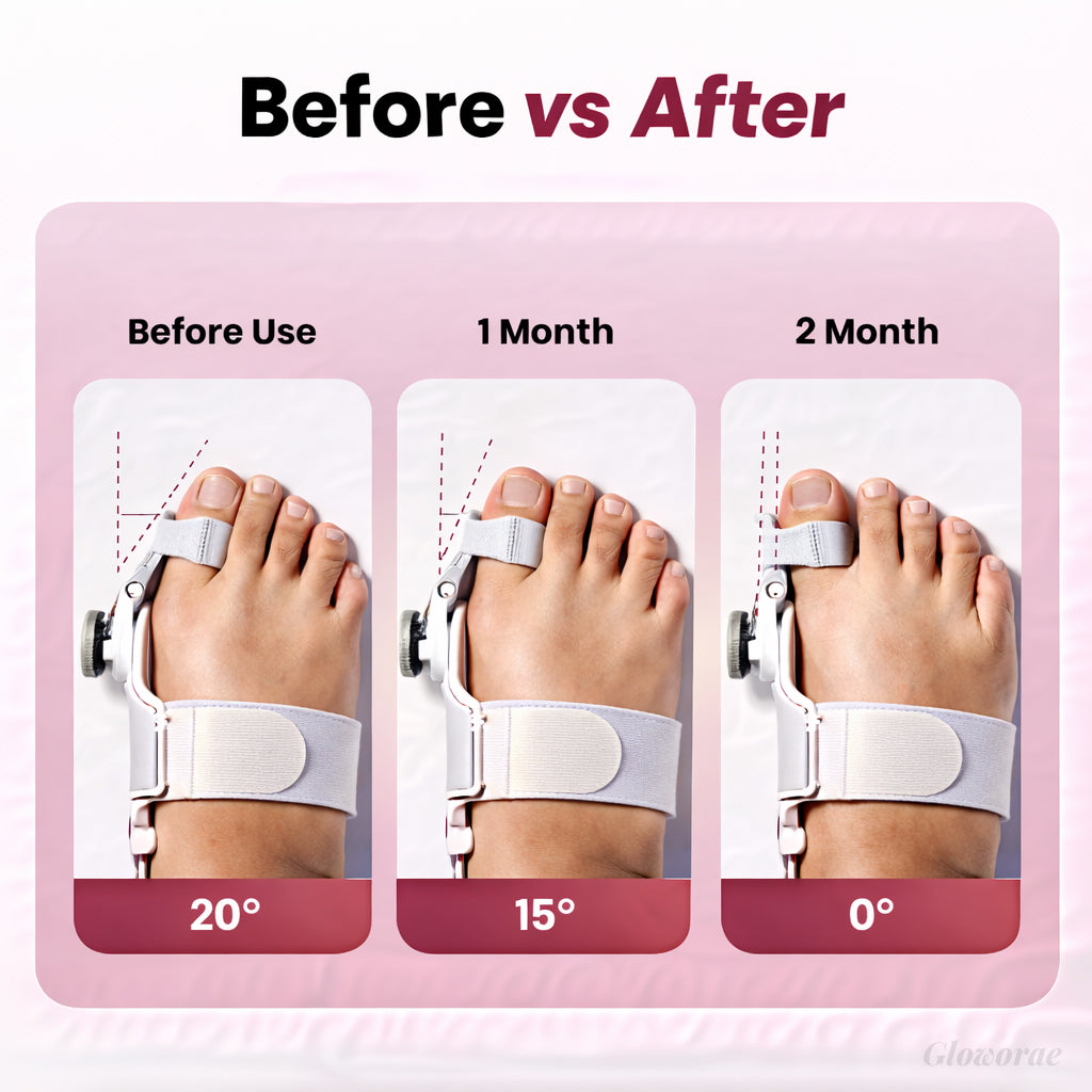 PediAlign™ Bunion Corrector