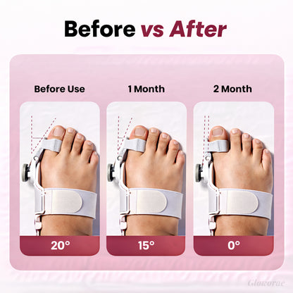 PediAlign™ Bunion Corrector